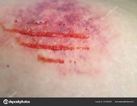 depositphotos_201000496-stock-photo-hematoma-soft-tissue-injury.jpg