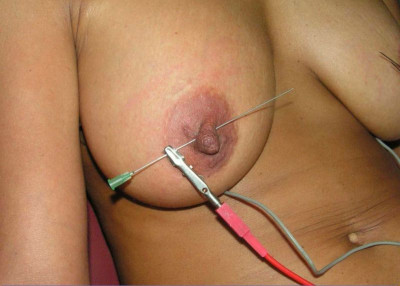 electroneedles1.jpg